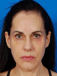 Woman face, Before Facial Fat Grafting Treatment, front view, patient 9