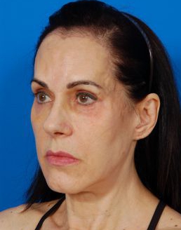 Woman face, Before Facial Fat Grafting Treatment, oblique view, patient 9