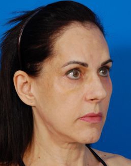 Woman face, Before Facial Fat Grafting Treatment, right side oblique view, patient 9