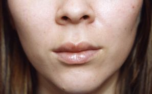 Female face, after Lip Enhancement treatment, front view patient 1