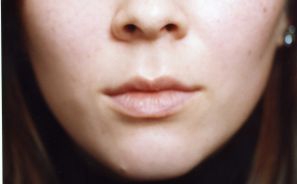 Female face, before Lip Enhancement treatment, front view patient 1