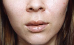 Female face, after Lip Enhancement treatment, front view - patient 1