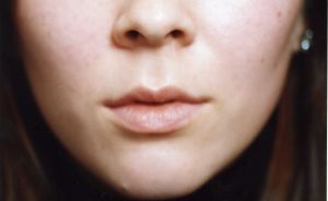 Female face, before Lip Enhancement treatment, front view - patient 1