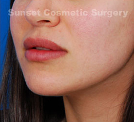Woman's lips, after Lip Lift and Lip Reduction treatment, l-side view, patient 1