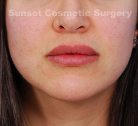 Woman's lips, after Lip Lift and Lip Reduction treatment, front view, patient 1