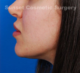 Woman's lips, after Lip Lift and Lip Reduction treatment, l-side oblique view, patient 1