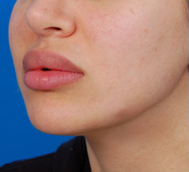 Woman's lips, before Lip Lift and Lip Reduction treatment, l-side view, patient 1