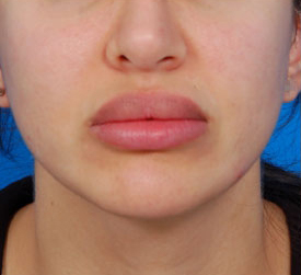 Woman's lips, before Lip Lift and Lip Reduction treatment, front view, patient 1