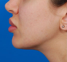 Woman's lips, before Lip Lift and Lip Reduction treatment, l-side oblique view, patient 1