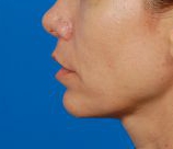 Woman's lips, after Lip Lift and Lip Reduction treatment, l-side view, patient 126