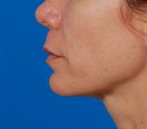 Woman's lips, before Lip Lift and Lip Reduction treatment, l-side view, patient 126