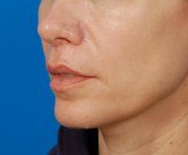 Woman's lips, after Lip Lift and Lip Reduction treatment, l-side oblique view, patient 126