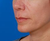 Woman's lips, before Lip Lift and Lip Reduction treatment, l-side oblique view, patient 126