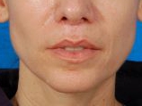 Woman's lips, after Lip Lift and Lip Reduction treatment, front view, patient 126