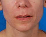 Woman's lips, before Lip Lift and Lip Reduction treatment, front view, patient 126