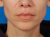 Woman's lips, after Lip Lift and Lip Reduction treatment, front view (lips closed), patient 126