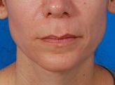 Woman's lips, before Lip Lift and Lip Reduction treatment, front view (lips closed), patient 126