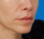 Woman's lips, after Lip Lift and Lip Reduction treatment, r-side oblique view, patient 126