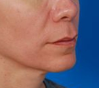 Woman's lips, before Lip Lift and Lip Reduction treatment, r-side oblique view, patient 126