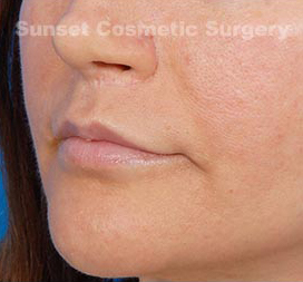 Woman's lips, after Facial Fat Grafting treatment, l-side oblique view, patient 2