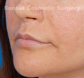 Woman's lips, after Facial Fat Grafting treatment, l-side oblique view, patient 2