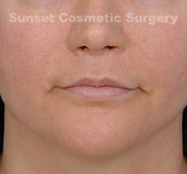 Woman's lips, after Facial Fat Grafting treatment, front view, patient 2