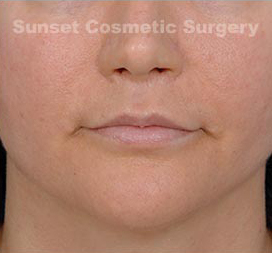 Woman's lips, after Facial Fat Grafting treatment, front view, patient 2