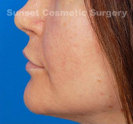 Woman's lips, after Facial Fat Grafting treatment, l-side view, patient 2