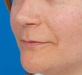 Woman's lips, before Facial Fat Grafting treatment, l-side oblique view, patient 2