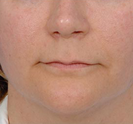 Woman's lips, before Facial Fat Grafting treatment, front view, patient 2