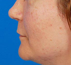 Woman's lips, before Facial Fat Grafting treatment, l-side view, patient 2