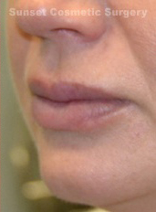 Woman's lips, after Lip Lift and Lip Reduction treatment, l-side oblique view, patient 5