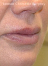 Woman's lips, after Lip Lift and Lip Reduction treatment, r-side oblique view, patient 5