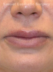 Woman's lips, after Lip Lift and Lip Reduction treatment, front view (lips closed), patient 5