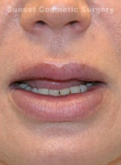 Woman's lips, after Lip Lift and Lip Reduction treatment, front view, patient 5