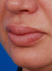 Woman's lips, before Lip Lift and Lip Reduction treatment, l-side oblique view, patient 5