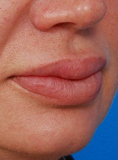 Woman's lips, before Lip Lift and Lip Reduction treatment, r-side oblique view, patient 5