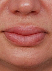 Woman's lips, before Lip Lift and Lip Reduction treatment, front view (lips closed), patient 5