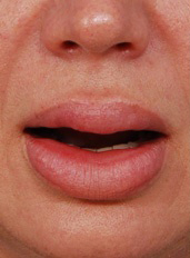 Woman's lips, before Lip Lift and Lip Reduction treatment, front view, patient 5