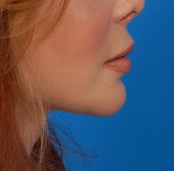 Woman's lips, after Lip Lift and Lip Reduction treatment, r-side view, patient 6