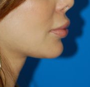 Woman's lips, before Lip Lift and Lip Reduction treatment, r-side view, patient 6