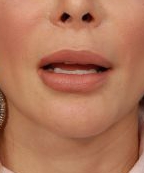 Woman's lips, after Lip Lift and Lip Reduction treatment, front view, patient 6