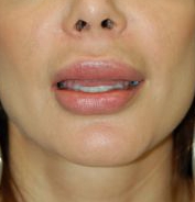 Woman's lips, before Lip Lift and Lip Reduction treatment, front view, patient 6