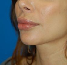 Woman's lips, before Lip Lift and Lip Reduction treatment, l-side oblique view, patient 6