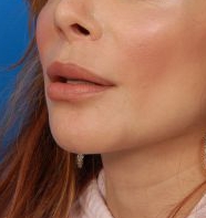 Woman's lips, after Lip Lift and Lip Reduction treatment, l-side oblique view, patient 6
