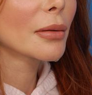 Woman's lips, after Lip Lift and Lip Reduction treatment, r-side oblique view, patient 6
