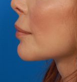 Woman's lips, after Lip Lift and Lip Reduction treatment, l-side view, patient 6