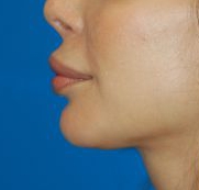 Woman's lips, before Lip Lift and Lip Reduction treatment, l-side view, patient 6