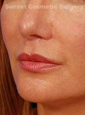 Woman's lips, after Lip Lift and Lip Reduction treatment, l-side oblique view, patient 64