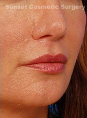 Woman's lips, after Lip Lift and Lip Reduction treatment, r-side oblique view, patient 64